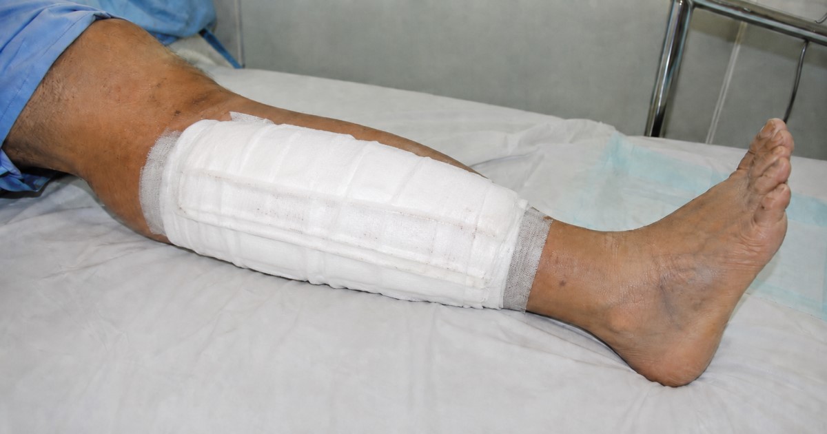Realistic post-revascularization vascular ward scene focused on monitoring for reperfusion injury and compartment syndrome.