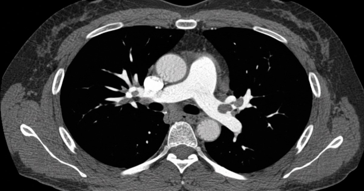 Medical visual of popliteal venous aneurysm as a hidden source of pulmonary embolism risk.