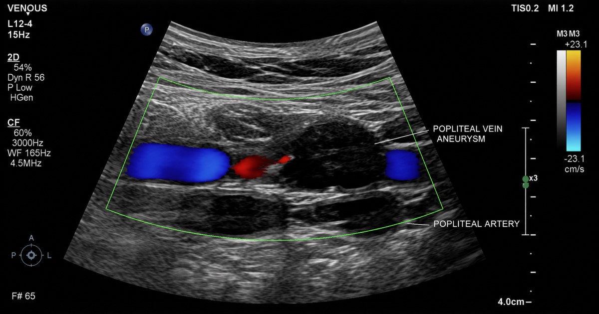 Duplex ultrasound style medical scene showing aneurysm size, morphology, and turbulent venous flow.