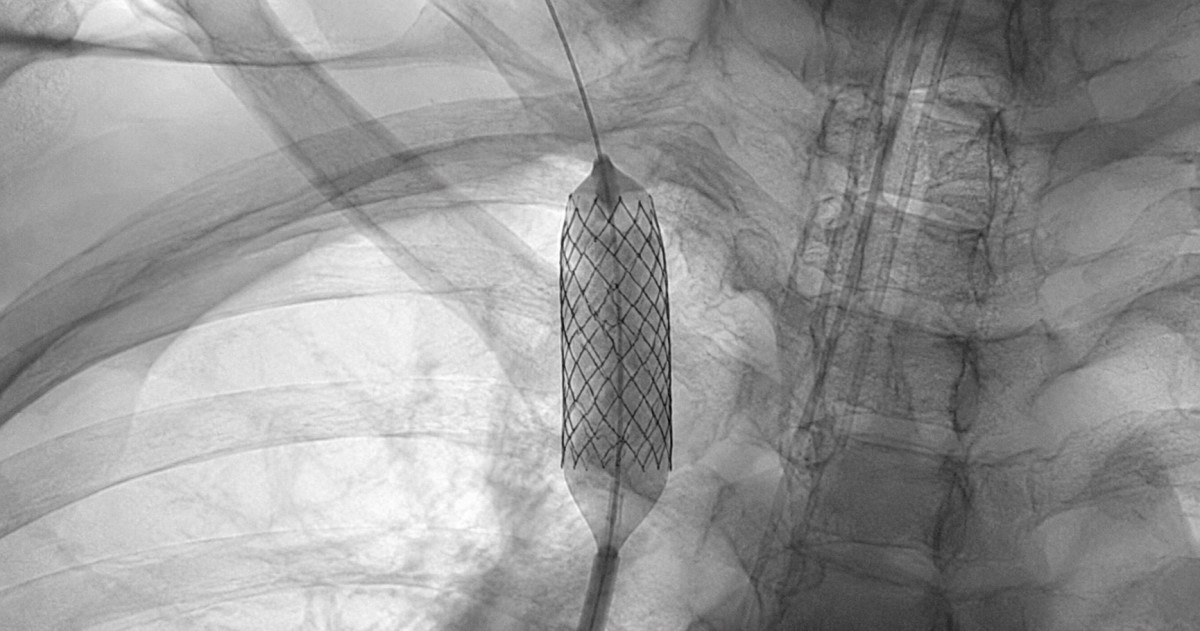 Realistic hospital image showing urgent endovascular treatment planning for superior vena cava syndrome.