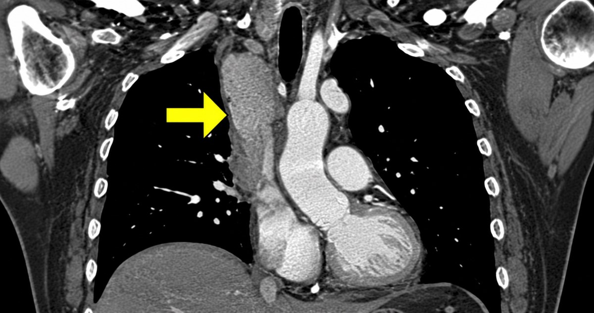 Realistic split clinical image suggesting lung cancer, mediastinal disease, catheters, pacemaker leads, and dialysis access.